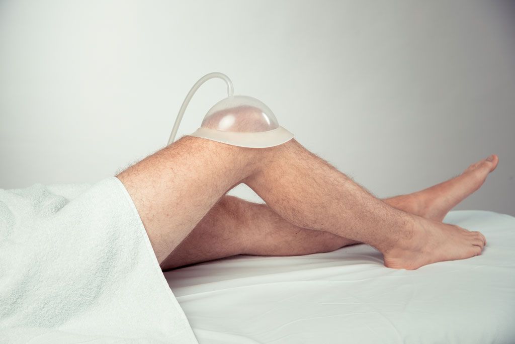 Pulsierende Schröpftherapie (PST)